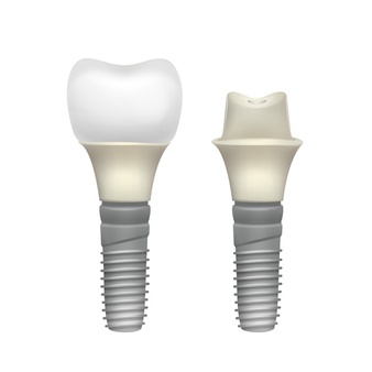 bay dental implants